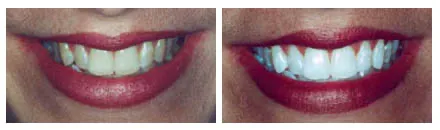 Cork City Teeth Whitening