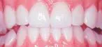 Lumineers Veneers