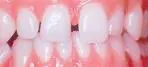 Lumineers Veneers