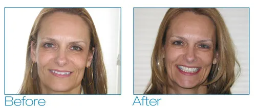 Six Month Smiles